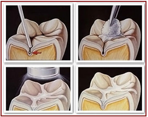Dental Sealants | Sharon Dental