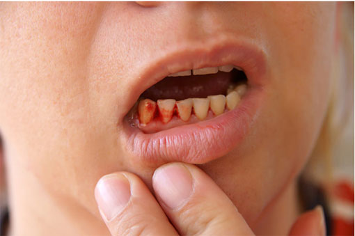 Bleeding Tooth | Sharon Dental
