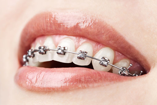 Braces | Sharon Dental